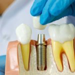 The Benefits of Getting Dental Implants